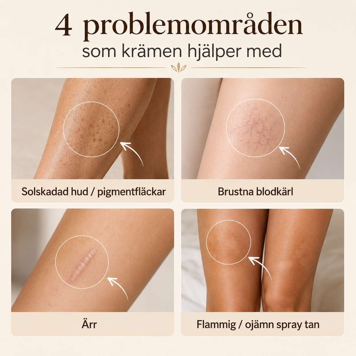 Body Cover – Dölj pigmentfläckar, bristningar och ärr 🫶🏼🫶🏽🫶🏾